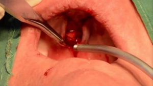 A surgical removal of a bony outgrowth on the palate image photo picture