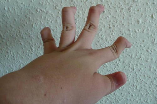 A case of vascular Ehlers Danlos syndrome hand picture
