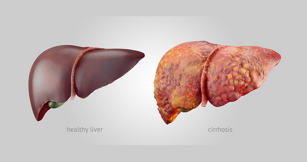 A comparison of healthy and cirrhosis liver image photo picture