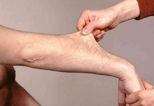 Elasticity of skin in Ehlers Danlos syndrome photos