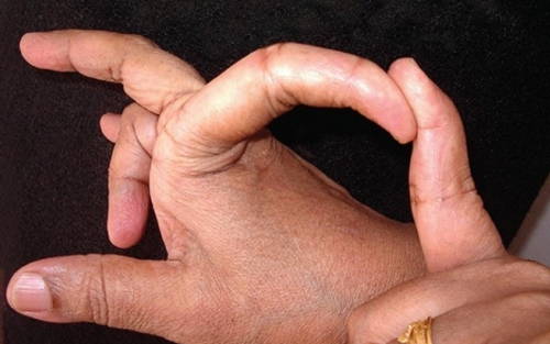 Hyper extensibility of fingers in Ehlers Danlos syndrome images