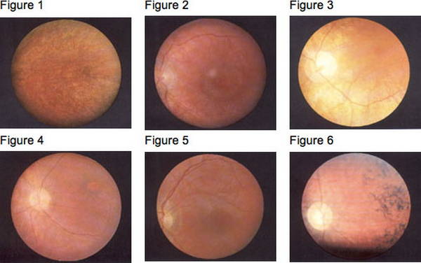 Ophthalmology based diagnosis of Batten Disease image photo picture