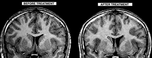 MRI scans of a PANDAS patient, showing reduced inflammation after treatment image photo picture